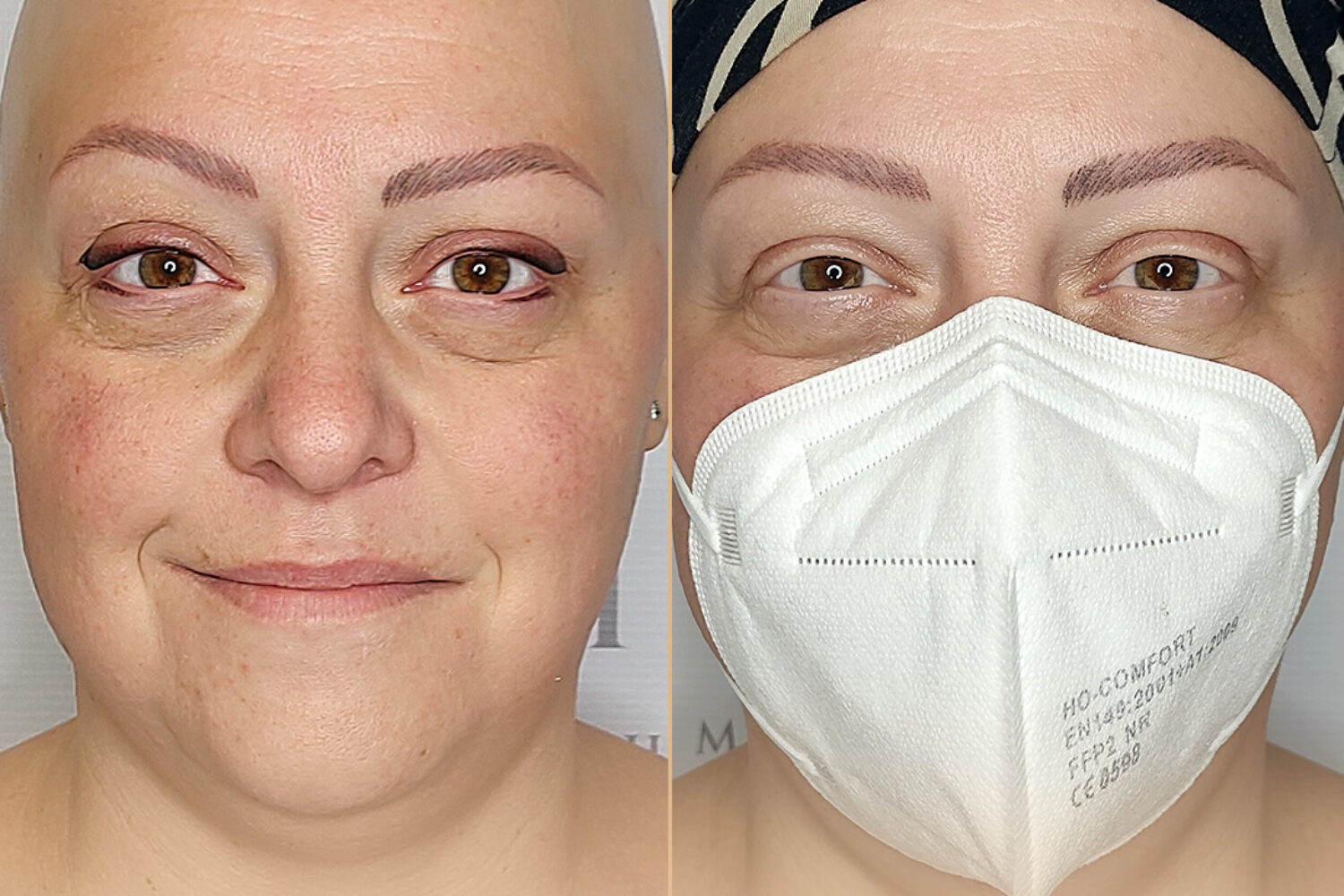 Eyeliner su alopecia con il trucco semipermanente