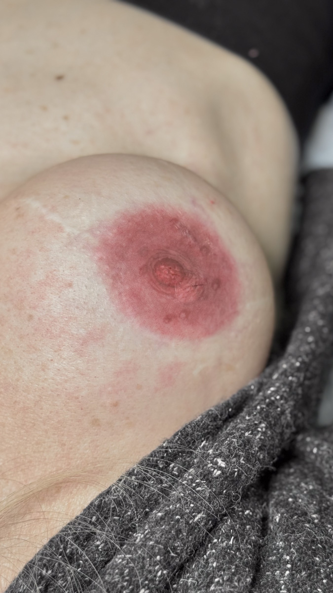 Dettaglio di un'areola ricostruita in 3D, appena eseguita