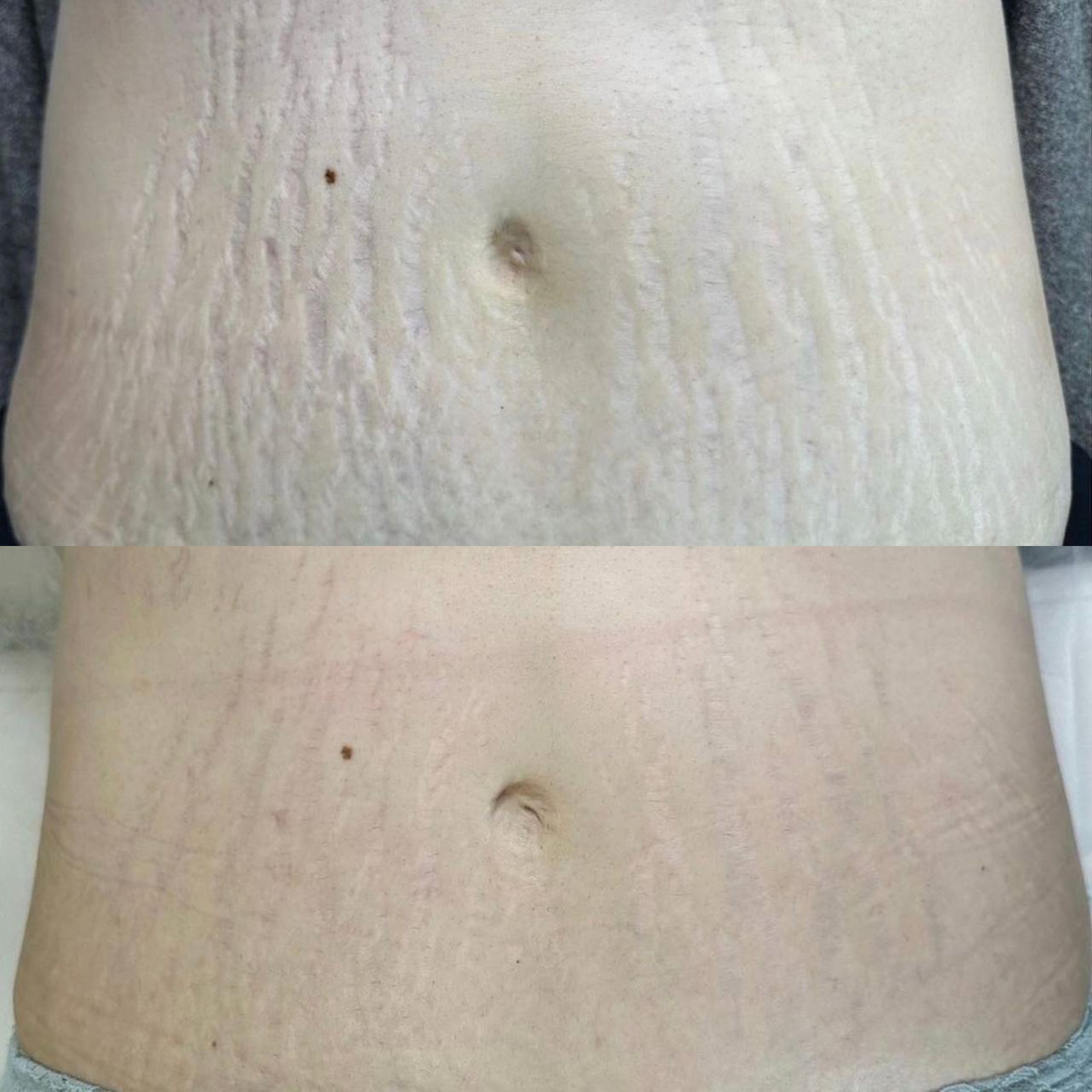 Addome con smagliature attorno all'ombelico, prima e dopo il trattamento