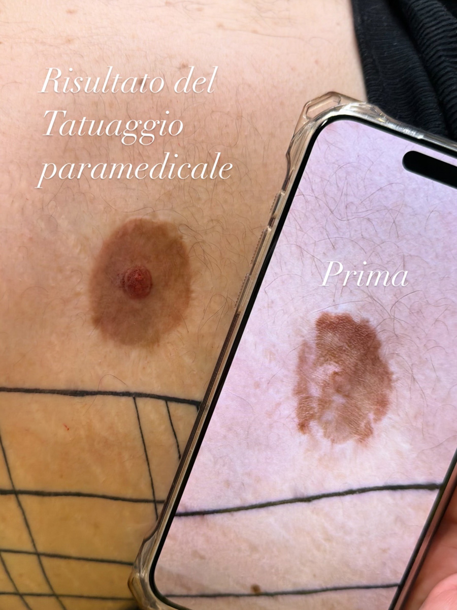 Areola maschile dopo la dermopigmentazione paramedicale, con la foto del prima sullo schermo del telefono