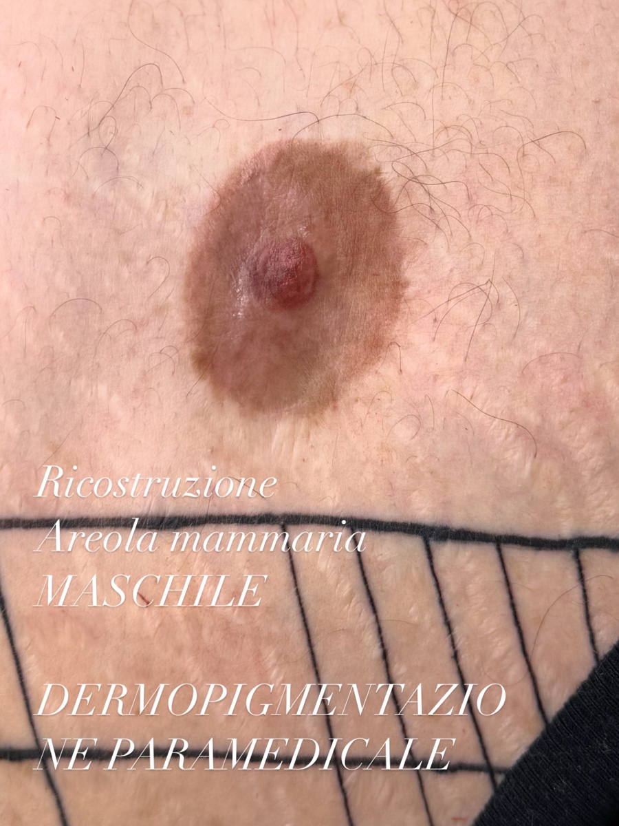 Areola maschile ricostruita con dermopigmentazione paramedicale