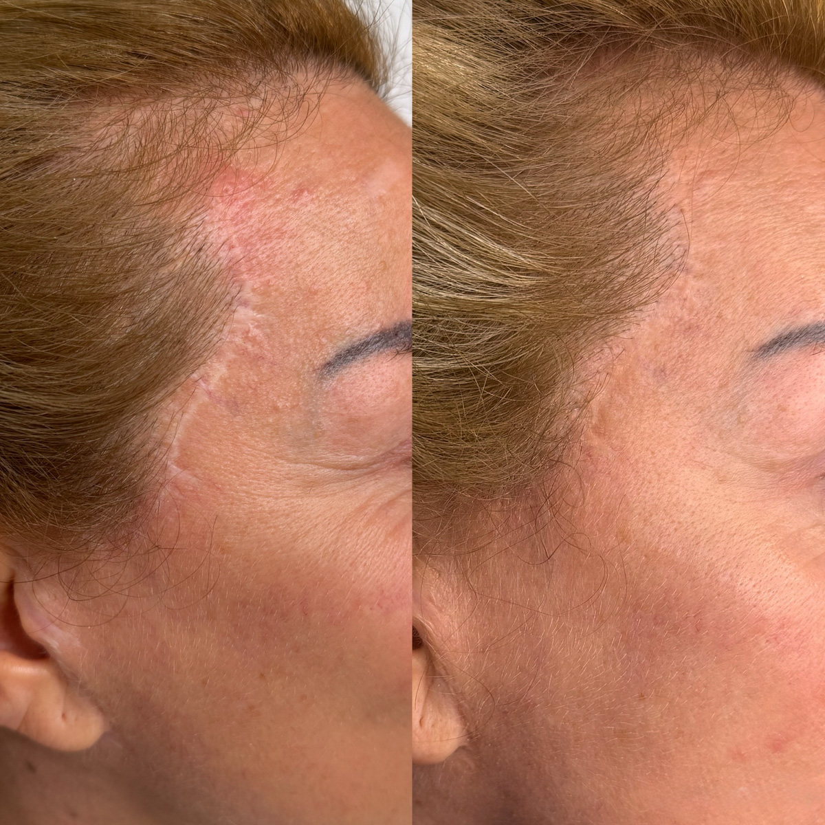 Cicatrice da trauma all'attaccatura dei capelli sulla tempia, prima e dopo il camouflage