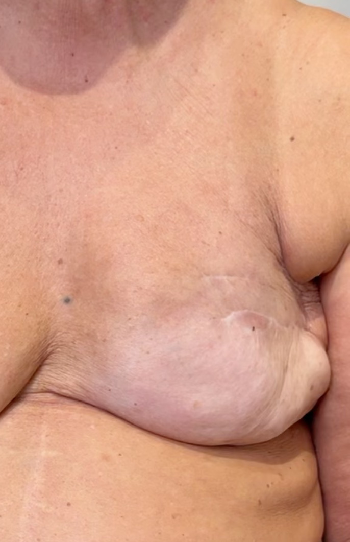 Seno ricostruito dopo mastectomia, prima della dermopigmentazione dell'areola