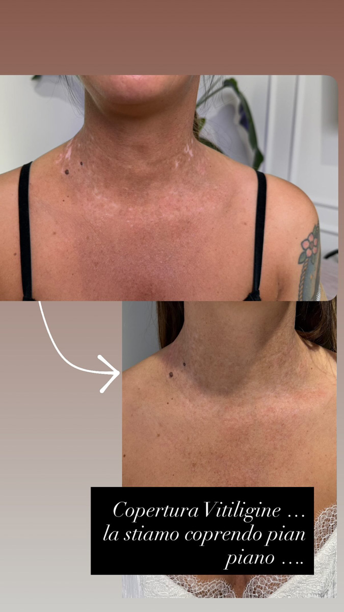 Vitiligine su collo e décolleté durante il trattamento di camouflage