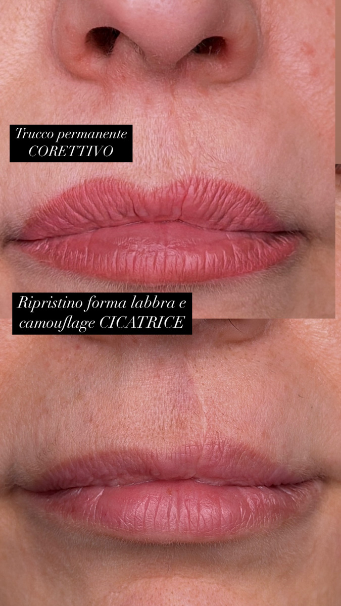 Labbra prima e dopo: camouflage di una cicatrice e ripristino della forma del labbro