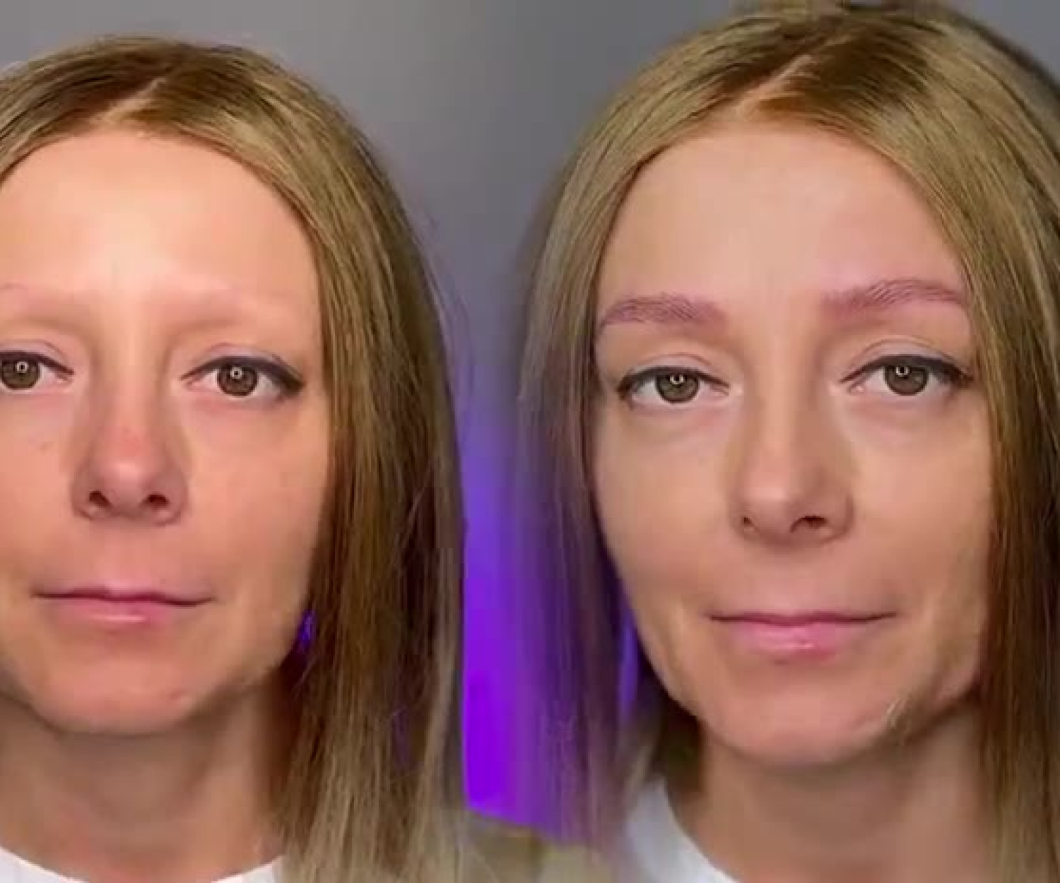 Alopecia delle sopracciglia: prima e dopo il trucco permanente